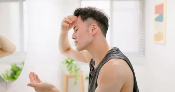 Alopecia masculina: cada vez más hombres buscan frenar la calvicie a tiempo