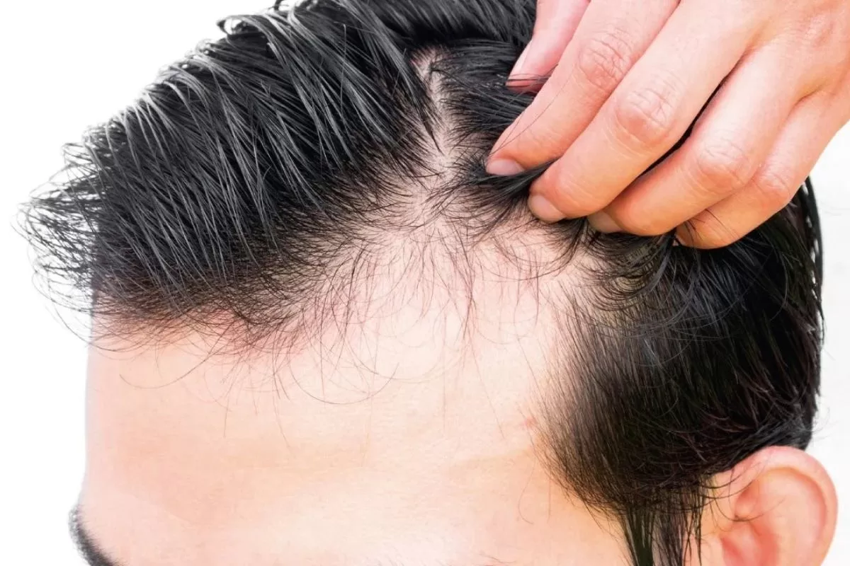 Entradas En El Cuero Cabelludo